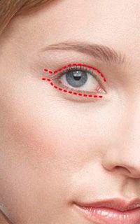 blefaroplastia